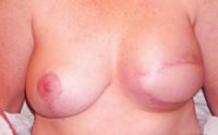 Breast Reconstruction Before & After Results