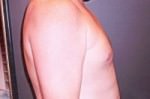Gynecomastia