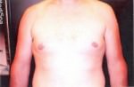 Gynecomastia