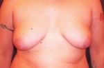 Gynecomastia