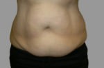 Exilis