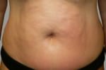 Exilis