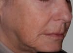 Exilis