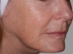 Exilis
