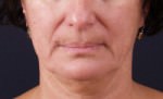 Exilis
