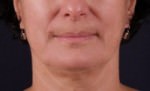 Exilis