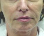 Exilis