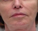 Exilis