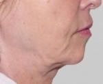 Exilis