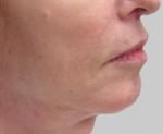 Exilis