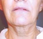 Restylane and Perlane