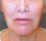 Restylane and Perlane