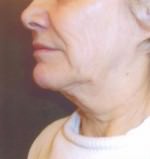 Restylane and Perlane