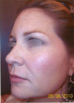 Restylane and Perlane