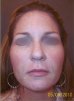 Restylane and Perlane