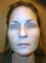 Restylane and Perlane