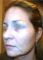 Restylane and Perlane