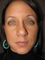 Restylane and Perlane