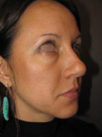 Restylane and Perlane