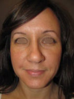 Restylane and Perlane