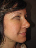 Restylane and Perlane