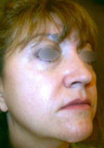 Restylane and Perlane