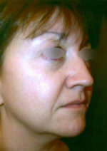 Restylane and Perlane