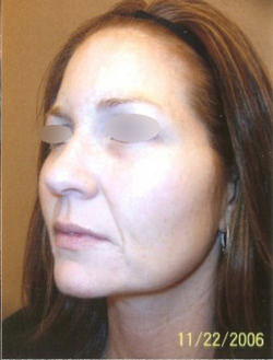 Intense Pulsed Light