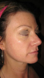 Restylane and Perlane