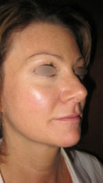 Restylane and Perlane