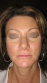 Restylane and Perlane