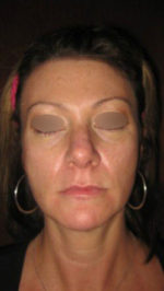 Restylane and Perlane