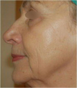 Exilis