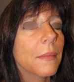 Restylane and Perlane