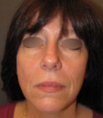 Restylane and Perlane