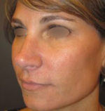 Restylane and Perlane