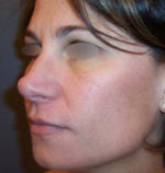 Restylane and Perlane