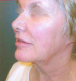 Restylane and Perlane