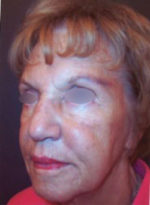 Restylane and Perlane