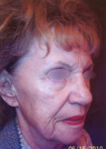 Restylane and Perlane