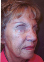 Restylane and Perlane