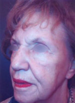 Restylane and Perlane