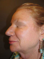 Restylane and Perlane