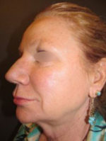 Restylane and Perlane