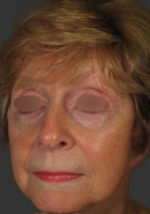 Exilis