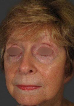 Exilis