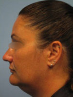 Exilis