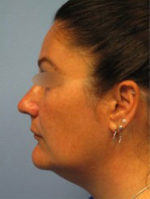 Exilis