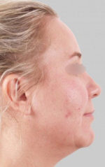 Exilis