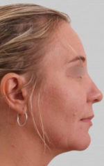 Exilis